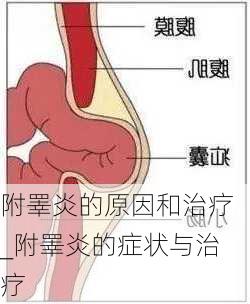 附睪炎的原因和治疗_附睪炎的症状与治疗