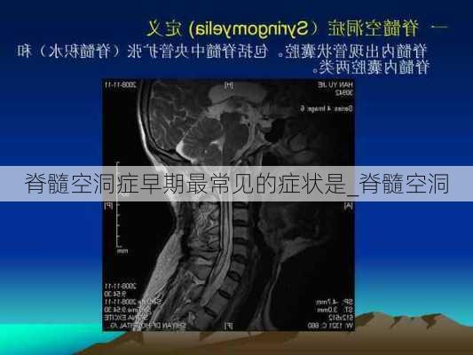 脊髓空洞症早期最常见的症状是_脊髓空洞