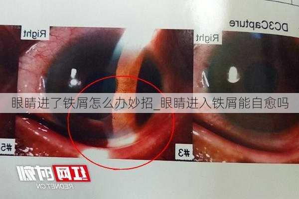 眼睛进了铁屑怎么办妙招_眼睛进入铁屑能自愈吗