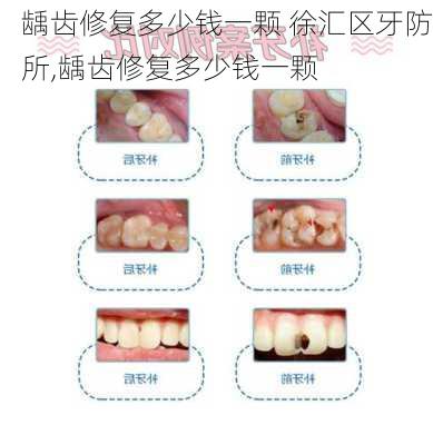 龋齿修复多少钱一颗 徐汇区牙防所,龋齿修复多少钱一颗